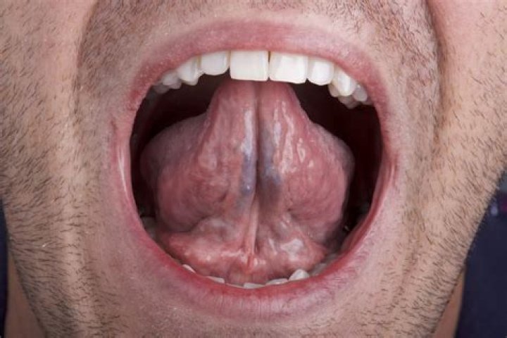 What does cancer under tongue look like