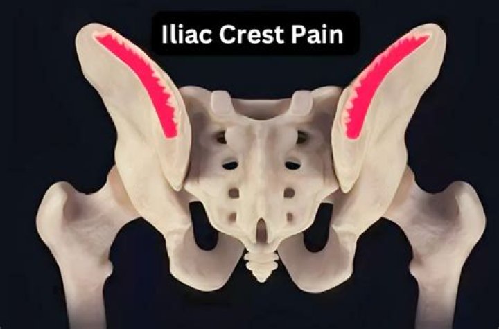 What does iliac crest pain feel like
