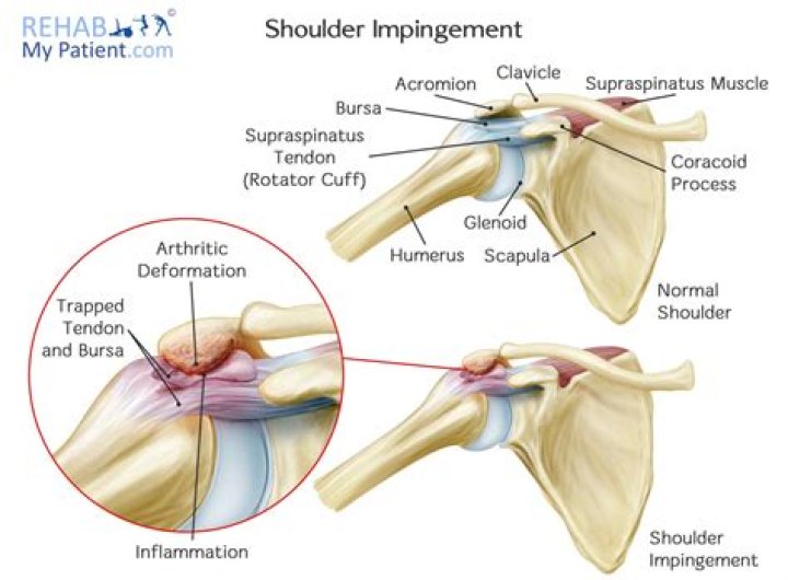 What does impingement mean