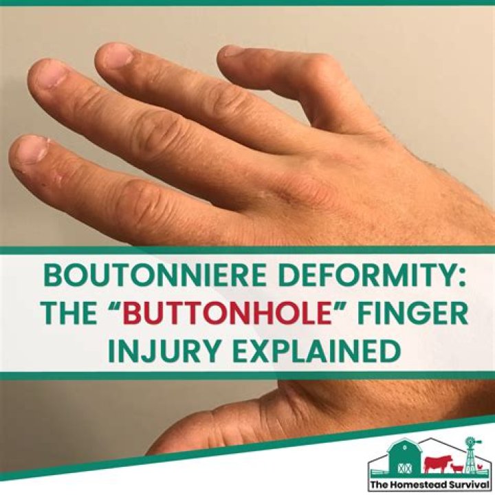 What is a boutonniere deformity