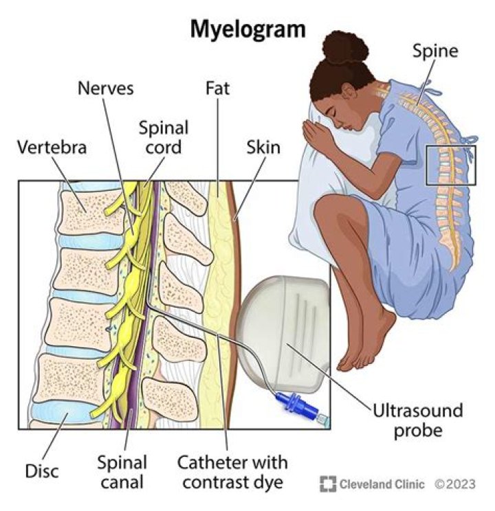 What is a cervical myelogram