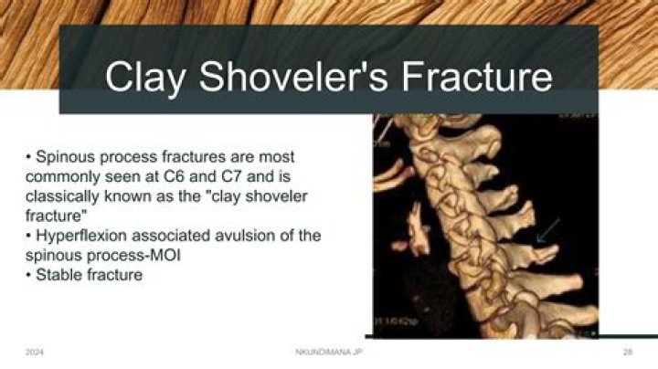 What is a clay shoveler's fracture?