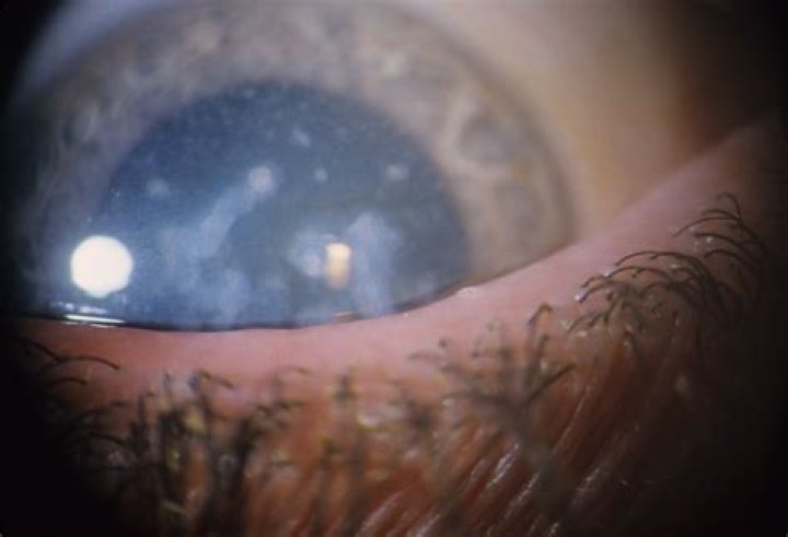 What is a corneal dystrophy