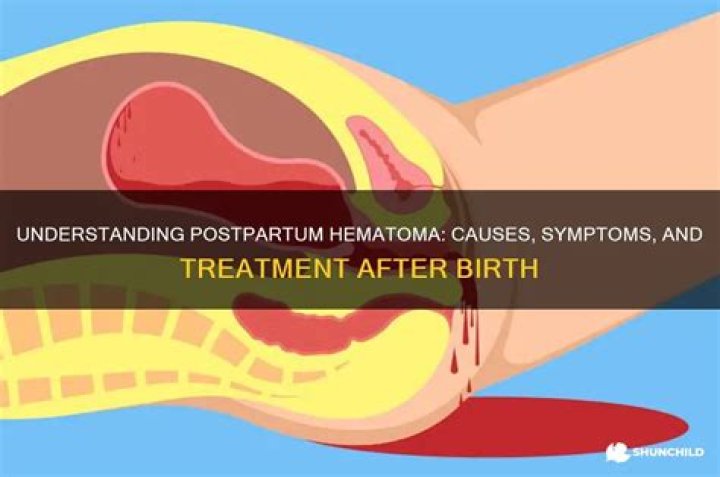 What is a hematoma after birth