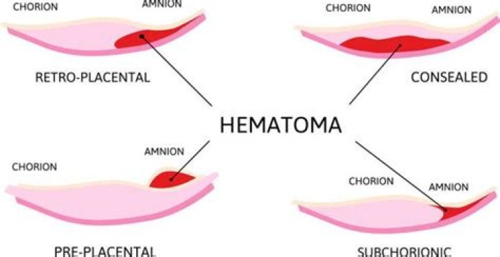 What is a hemorrhage in pregnancy