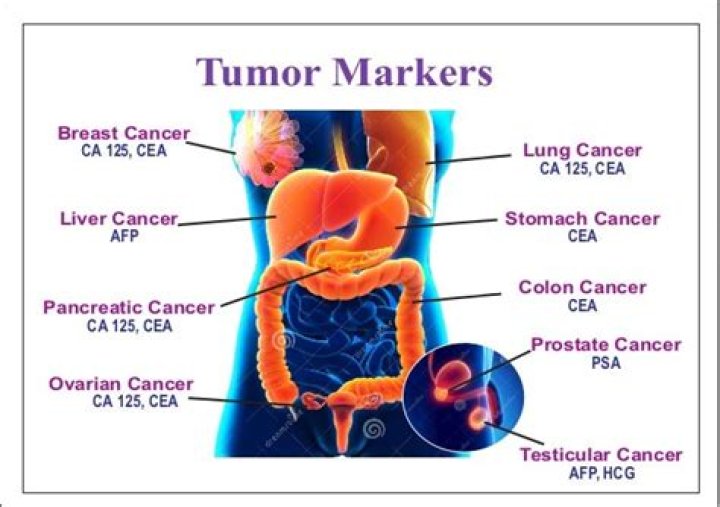 What is a high CEA level for colon cancer