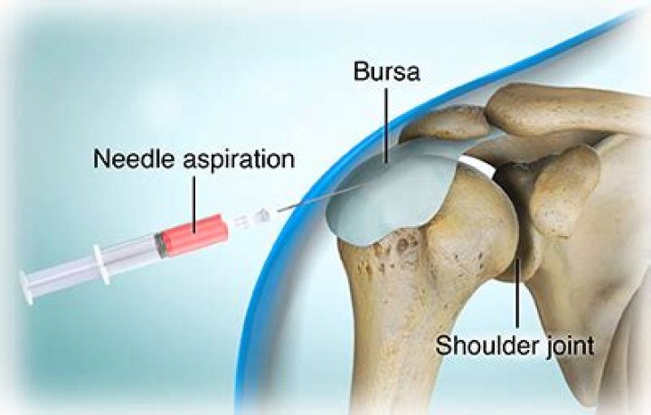 What is a joint aspiration?