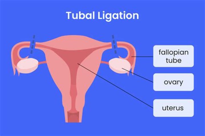 What is a ligation of AV fistula