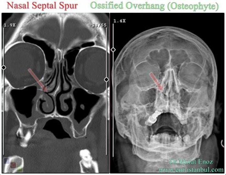 What is a nasal bone spur