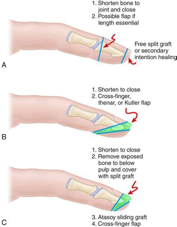What is a ray amputation of finger