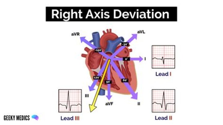 What is a right axis deviation in the heart