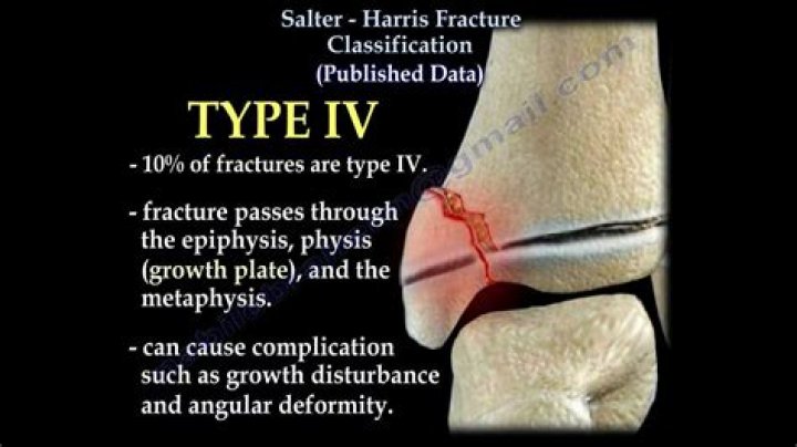 What is a Salter Harris type 4 fracture