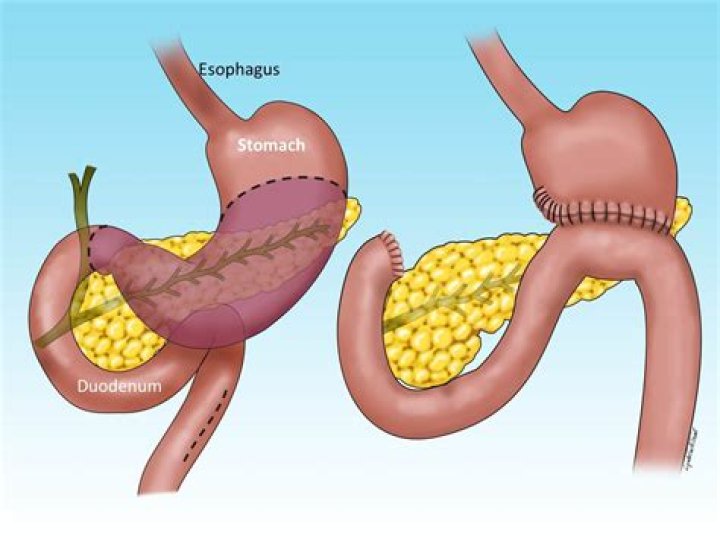 What is a stomach resection?