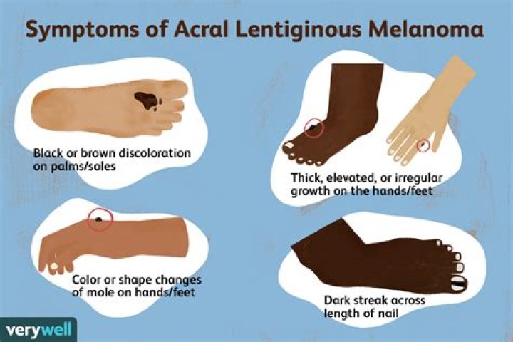 What is acral melanoma
