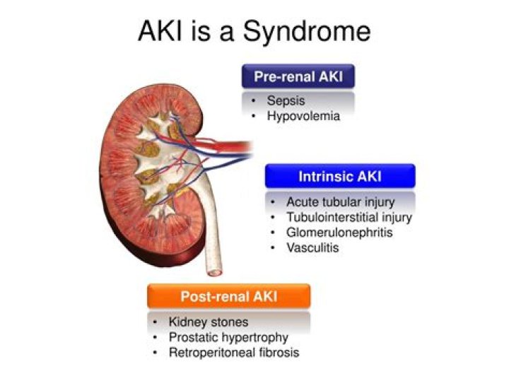 What is Aki in medical terms