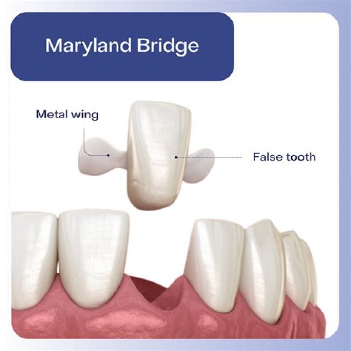 What is better a bridge or a crown