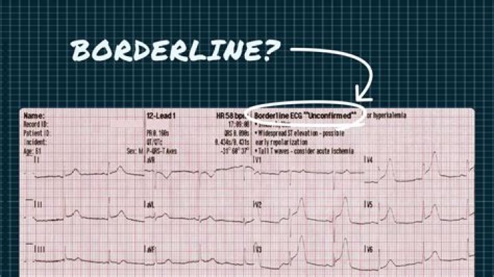 What is borderline ECG on EKG?
