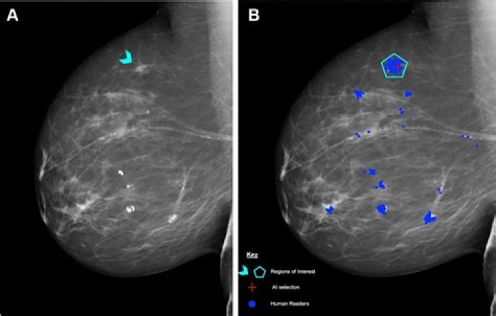 What is BSGI Breast Imaging