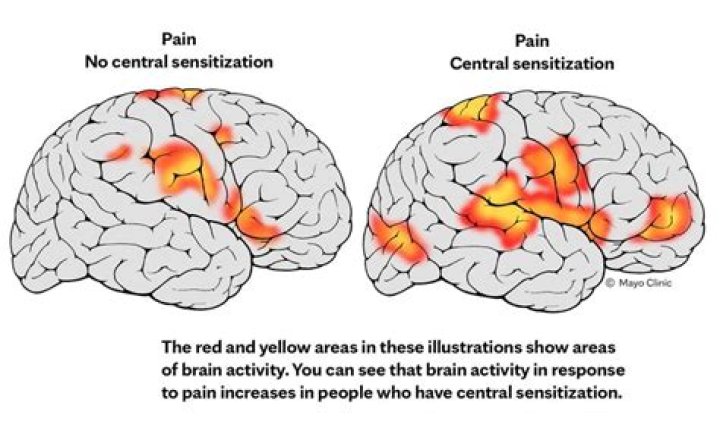 What is central sensitization