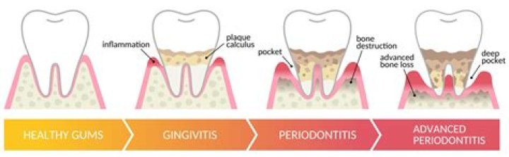 What is chronic periodontal gum disease