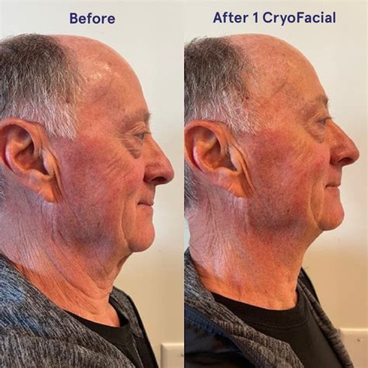 What is cryosurgery used for?