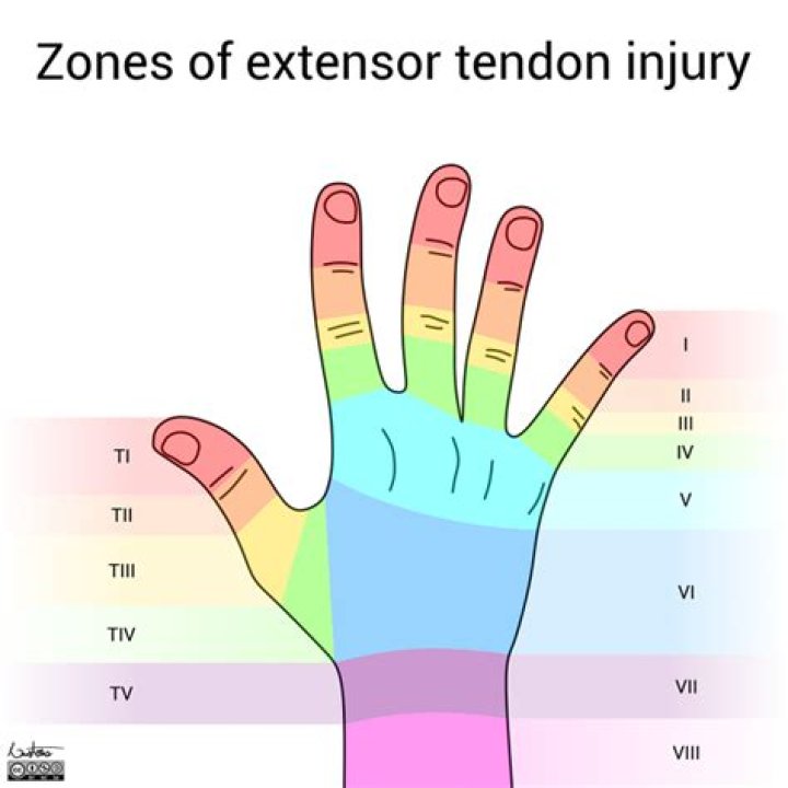 What is EIP tendon? | ContextResponse.com