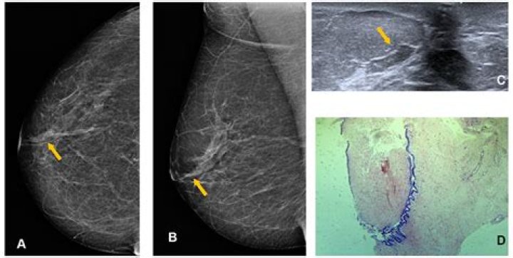What is Fibrosclerosis of breast