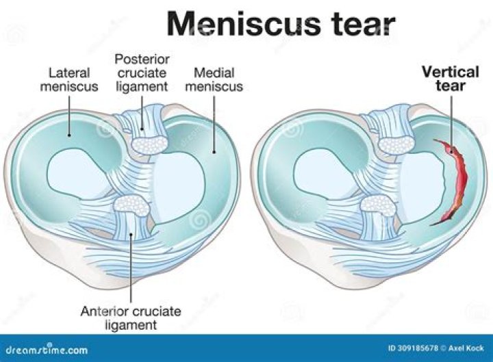 What is it called when you tear your ACL MCL and meniscus