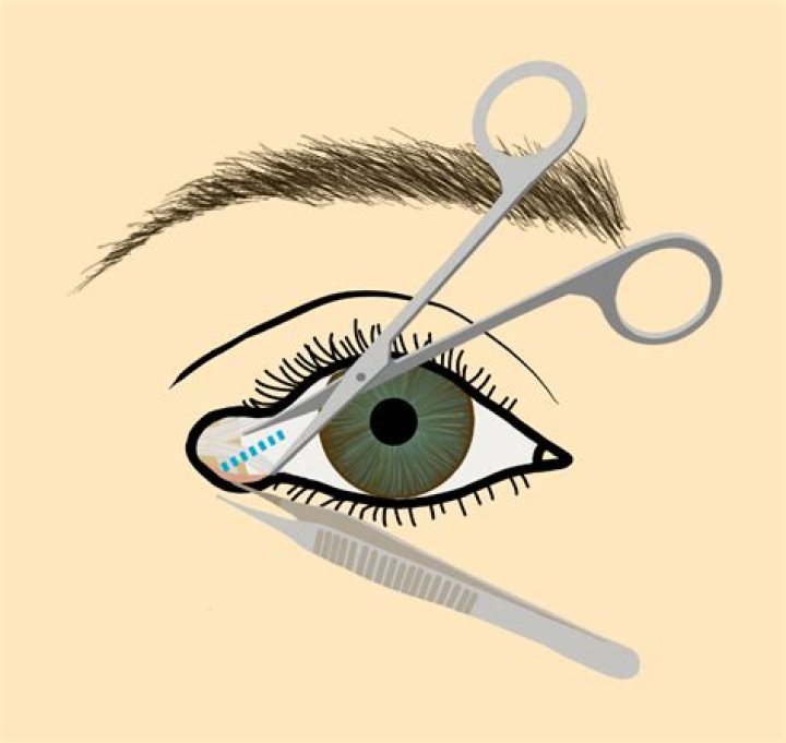 What is lateral Canthotomy