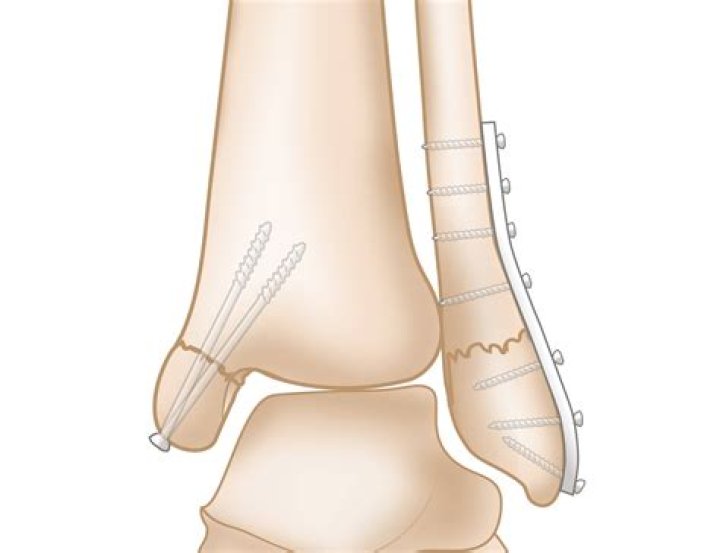 What is lateral malleolus fracture