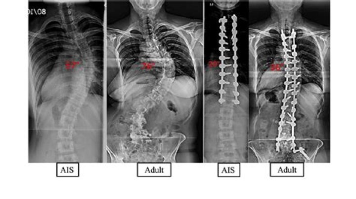 What is scoliosis of the lumbar spine?