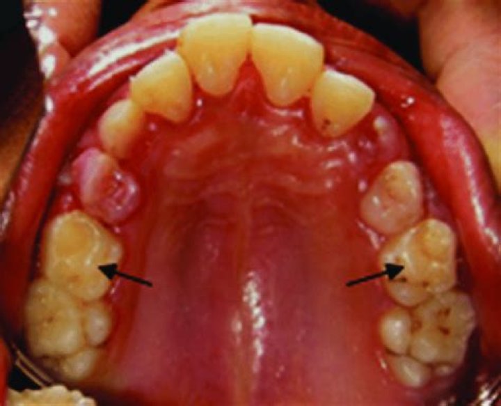 What is the cusp on a tooth