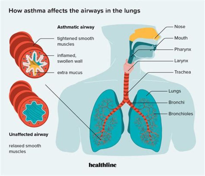 What is the description of asthma