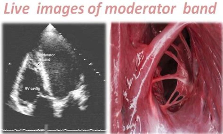 What is the moderator band of the heart