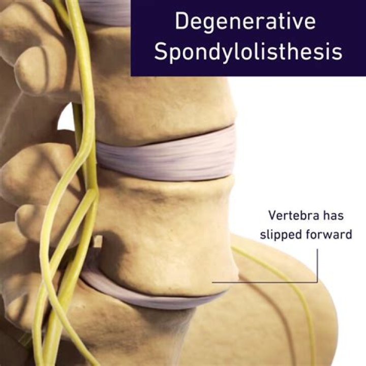 What is the treatment for degenerative spondylolisthesis?