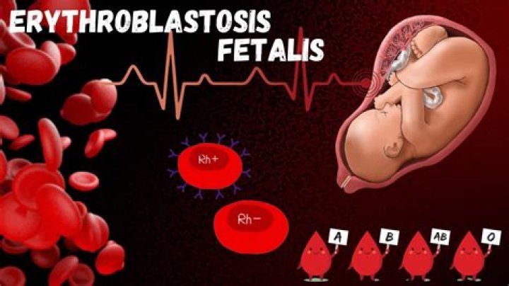 What is the treatment for Erythroblastosis Fetalis?