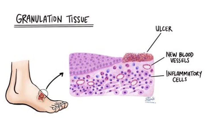 What is tissue granulation