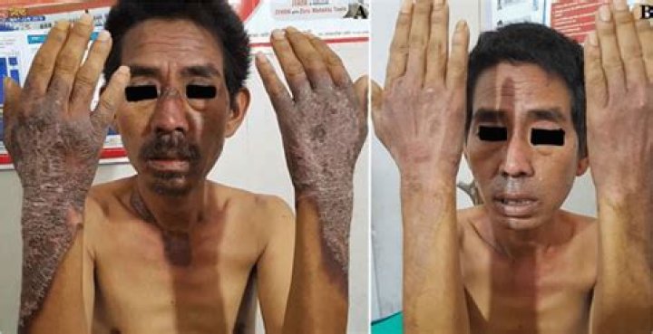 What type of disease is pellagra