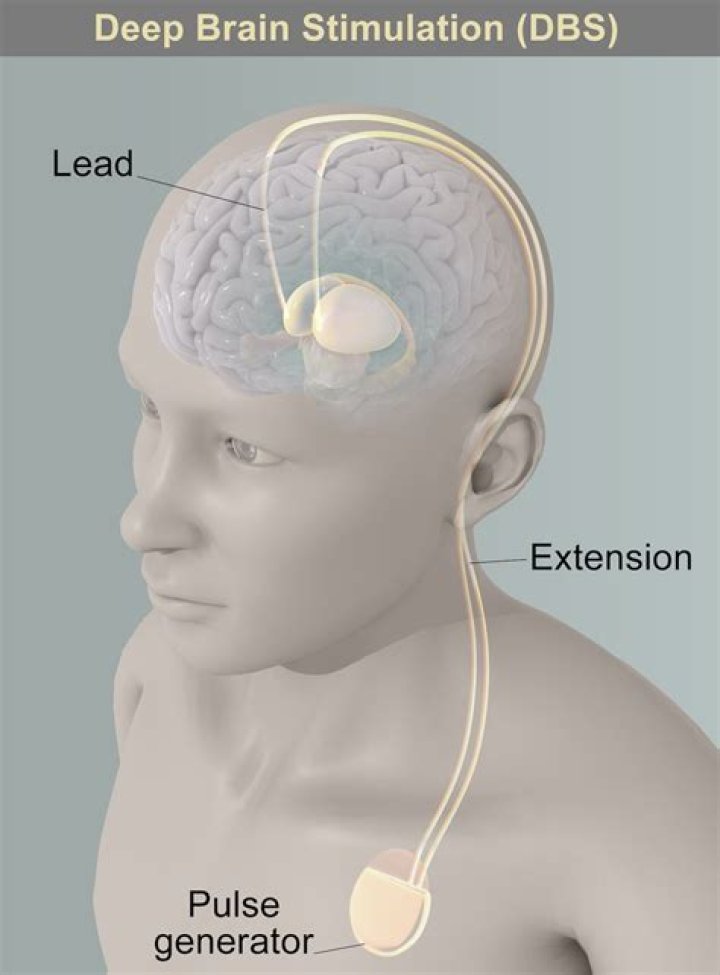 What type of therapy is deep brain stimulation?