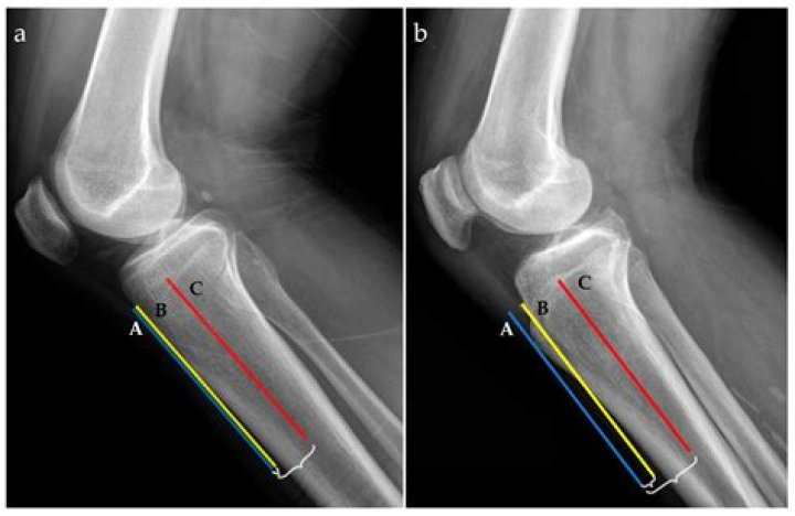 Where is the tibial vein