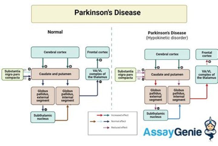 Which is related to the cause of Parkinsons disease quizlet