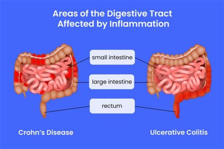 Which is worse Crohns or UC