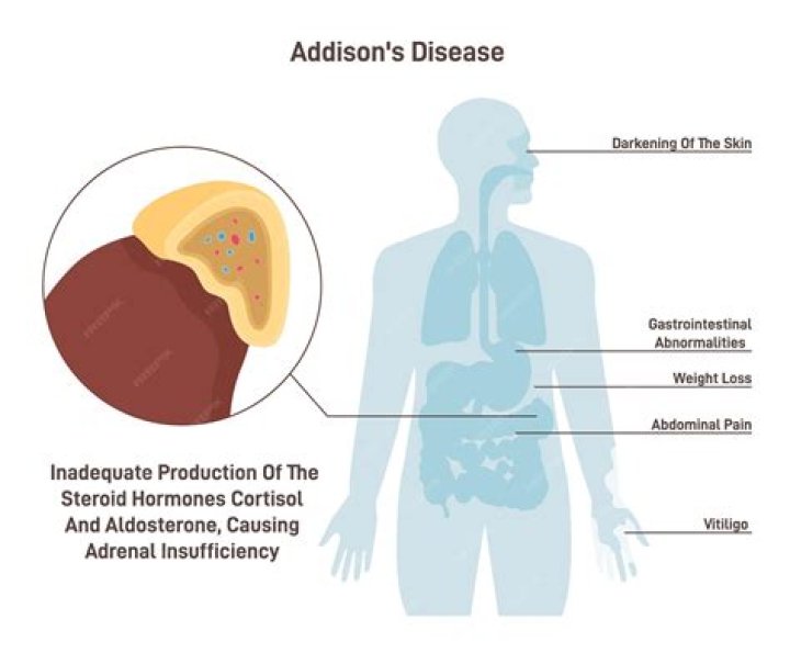 Who is at risk for Addison's disease?