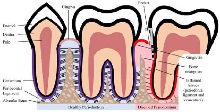 Who is at risk for periodontal disease