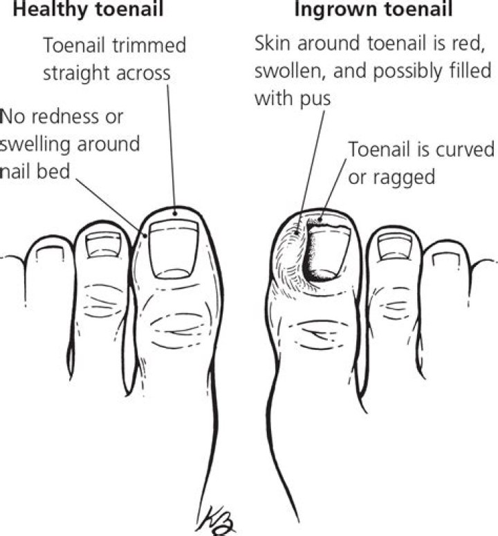 Why do I keep getting ingrown toenails?