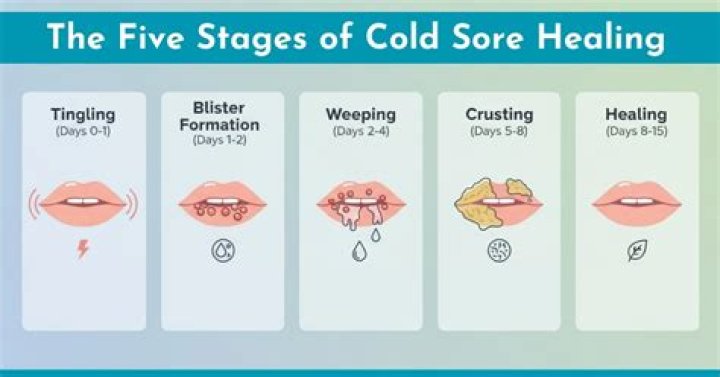 Why does Carmex help cold sores?
