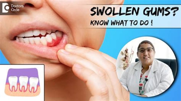 Why is the gum between my teeth swollen?