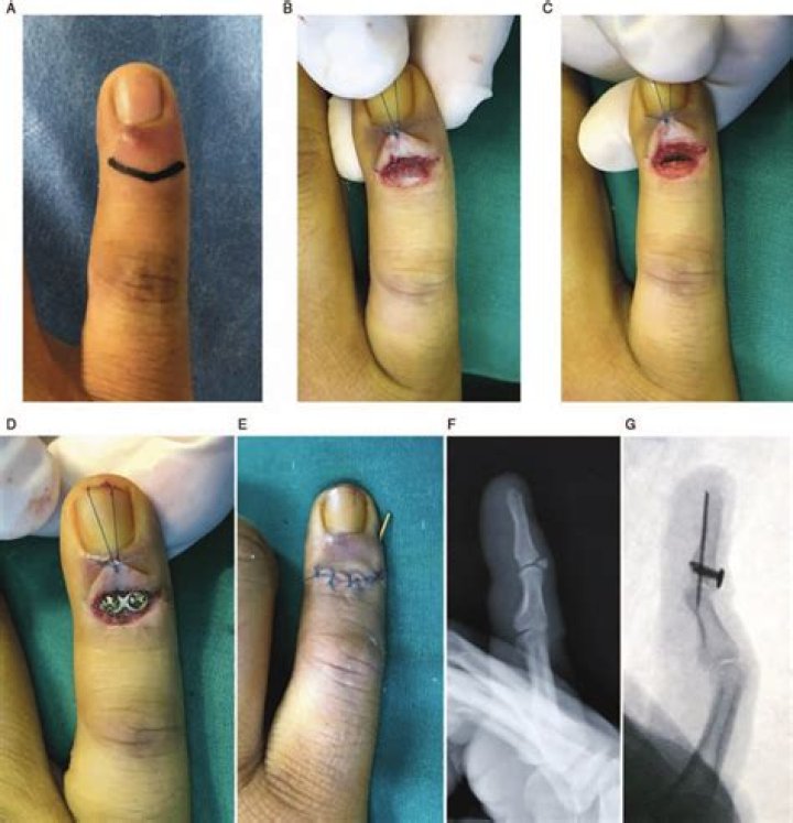 Will a broken thumb heal on its own?